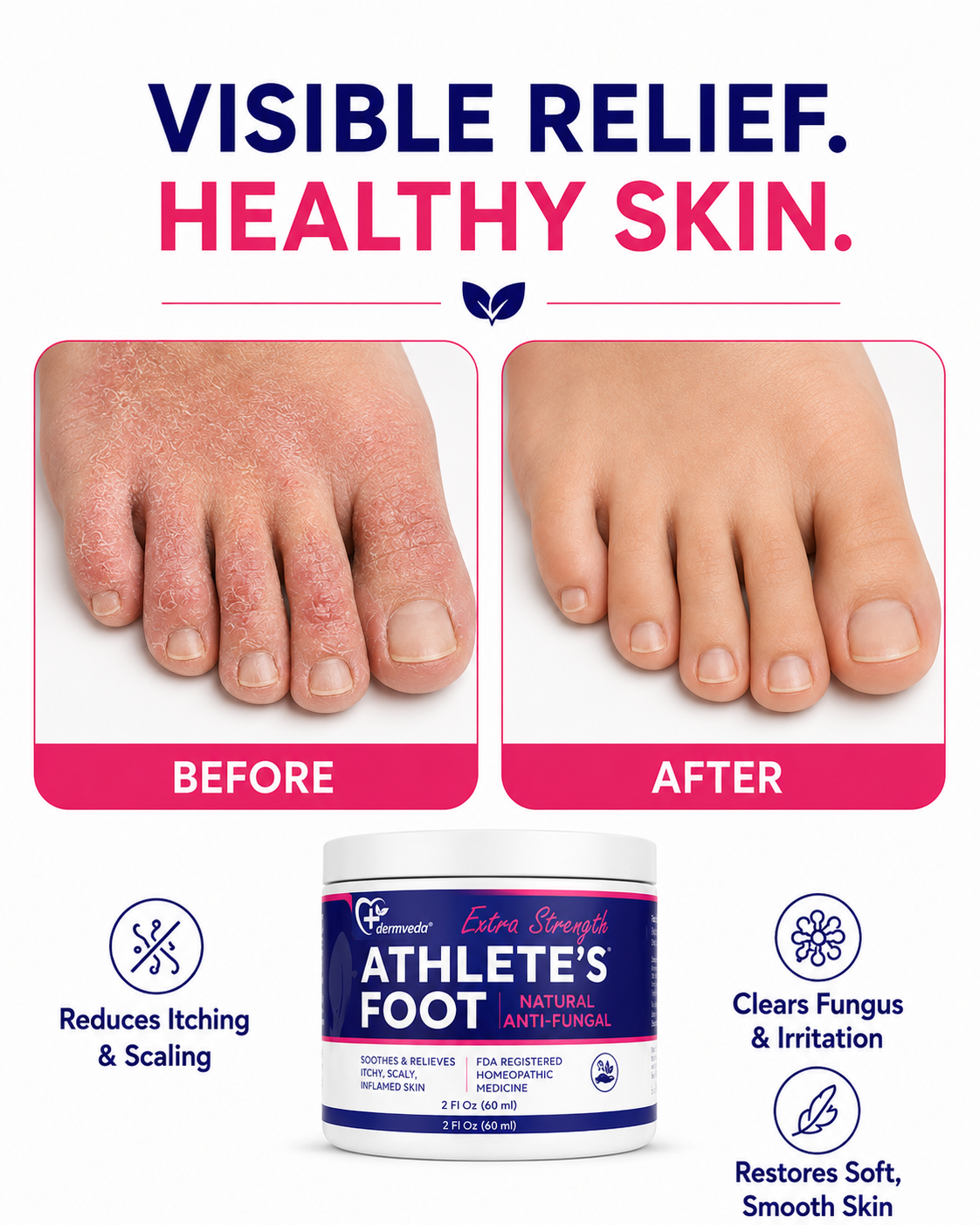 Athlete's foot before and after — flaky, red, cracked toes to visibly clear, smooth skin