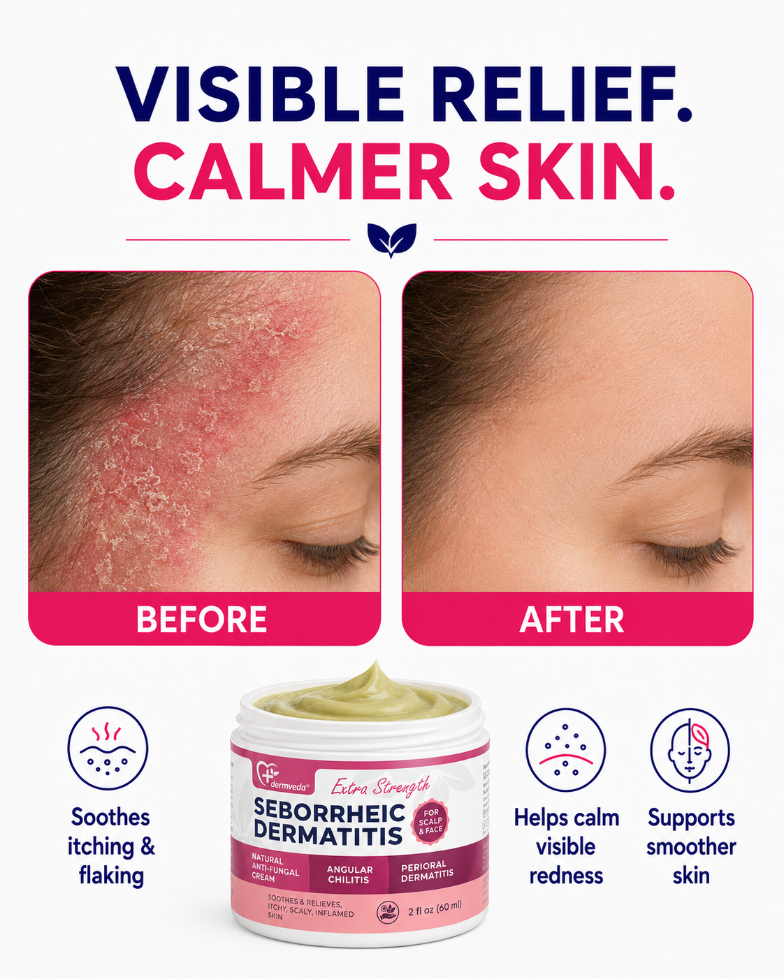 Seborrheic dermatitis before and after showing calmer, smoother-looking skin