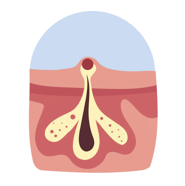 Diagram of a blocked, inflamed hair follicle