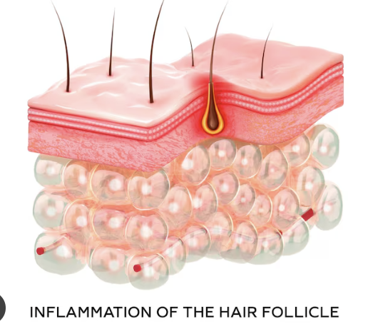 Illustration of inflammation around a hair follicle in the skin layers