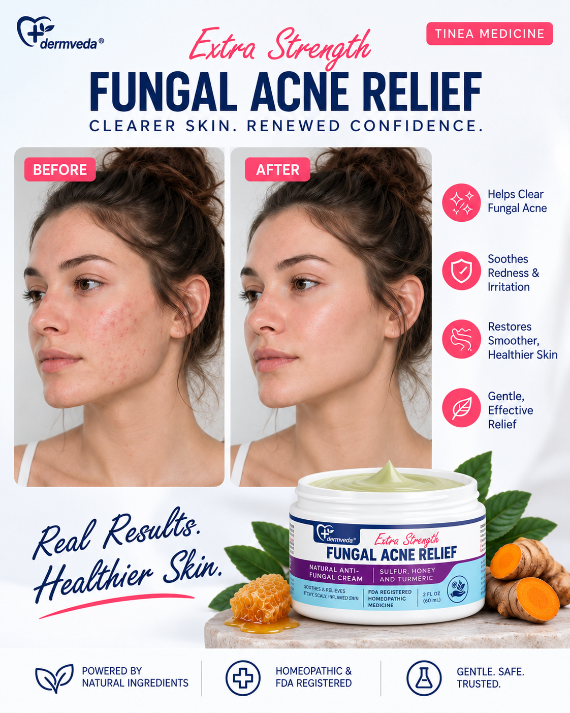 Fungal acne before and after results with clearer, healthier-looking skin