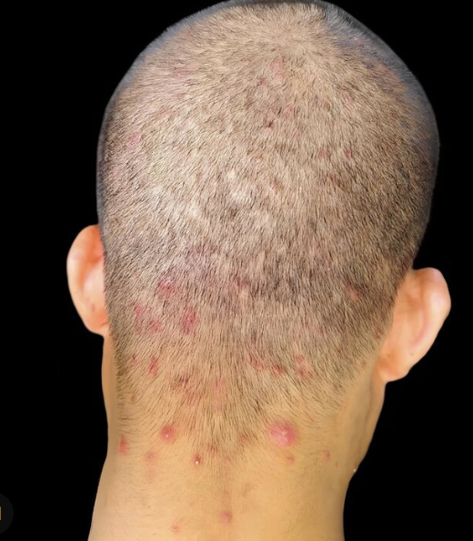Back of a closely-shaved head showing scattered red folliculitis bumps