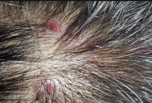 Close-up of inflamed pustules on a scalp between hairs
