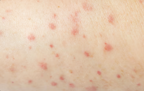 Close-up of red inflammatory bumps scattered across the skin