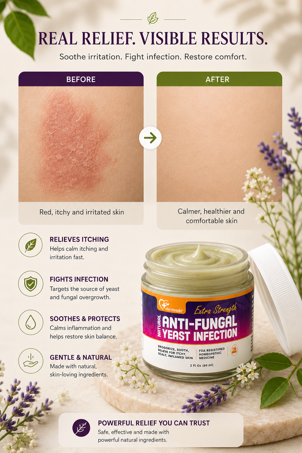 Before and after — Dermveda Anti-Fungal Yeast Infection Cream after consistent use